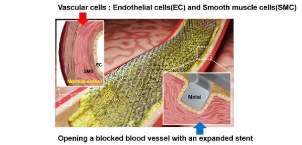 Bước tiến mới trong điều trị mạch máu: Công nghệ laser tăng hiệu quả stent